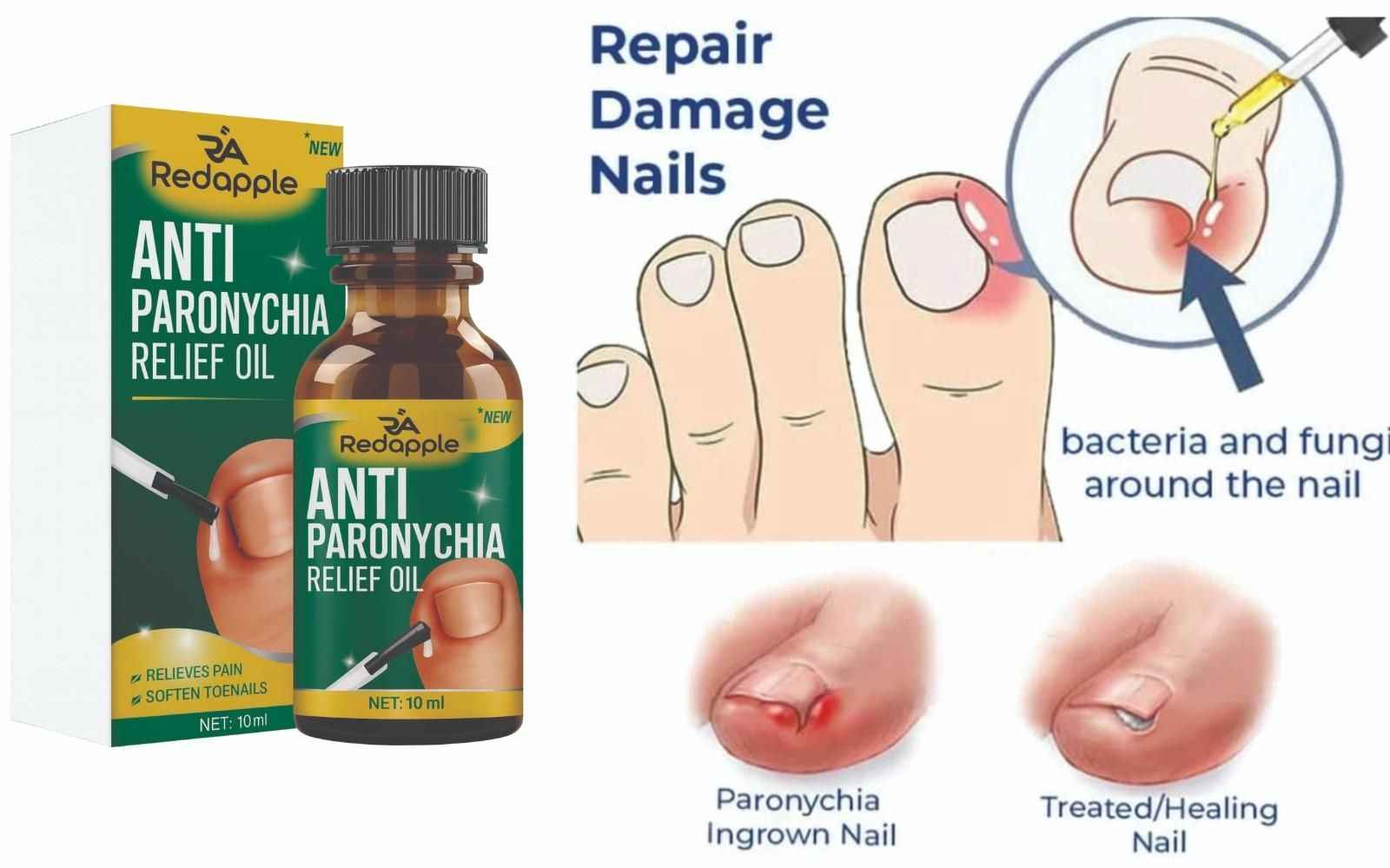 Anti Paronychia Relief Oil 10 ml Pack of 1
